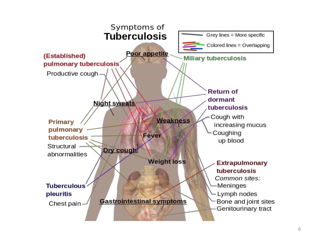 Tuberculosis Diagnosis and Treatment