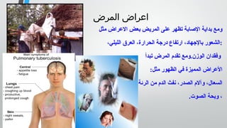 ‫المرض‬ ‫اعراض‬
‫مثل‬ ‫العراض‬ ‫بعض‬ ‫المريض‬ ‫على‬ ‫تظهر‬ ‫الاصابة‬ ‫بداية‬ ‫ومع‬
،‫الليلي‬ ‫العرق‬ ،‫الحرارة‬ ‫درجة‬ ‫ارتفاع‬ ،‫بالجهاد‬ ‫:الشعور‬
‫تبدأ‬ ‫المرض‬ ‫تقدم‬ ‫الوزن.ومع‬ ‫وفقدان‬
:‫مثل‬ ‫الظهور‬ ‫في‬ ‫المميزة‬ ‫العراض‬
‫الرئة‬ ‫من‬ ‫الدم‬ ‫نفث‬ ،‫الصدر‬ ‫وآلم‬ ،‫السعال‬
.‫الصوت‬ ‫وبحة‬ ،
 