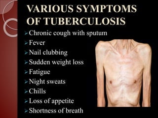 VARIOUS SYMPTOMS
OF TUBERCULOSIS
Chronic cough with sputum
Fever
Nail clubbing
Sudden weight loss
Fatigue
Night sweats
Chills
Loss of appetite
Shortness of breath
 