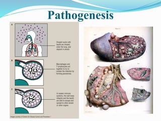 Pathogenesis
 
