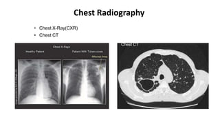 Chest Radiography
• Chest X-Ray(CXR)
• Chest CT
Chest CT
 
