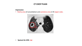 CT CHEST PLAIN
Impression:
• Patchy area of consolidation and cavitatory area in Rt Upper Lobe.
• Sputum for AFB: +ve
 