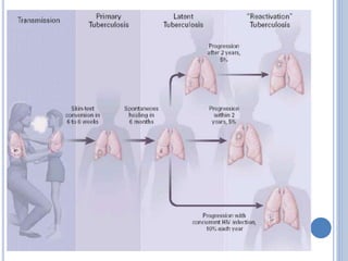 Tuberculosis | PPTX
