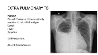 EXTRA PULMONARY TB
PLEURA
Pleural Effusion-a Hypersensitivity
reaction to microbial antigen
Cough
Fever
Dyspnea
Dull Percussion,
Absent Breath Sounds
 