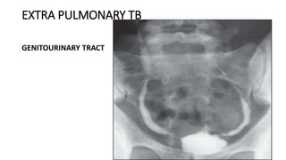 EXTRA PULMONARY TB
GENITOURINARY TRACT
 
