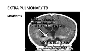 EXTRA PULMONARY TB
MENINGITIS
 