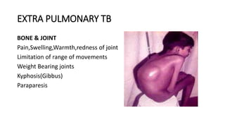 EXTRA PULMONARY TB
BONE & JOINT
Pain,Swelling,Warmth,redness of joint
Limitation of range of movements
Weight Bearing joints
Kyphosis(Gibbus)
Paraparesis
 