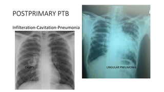 POSTPRIMARY PTB
Infilteration-Cavitation-Pneumonia
LINGULAR PNEUMONIACAVITY
 