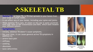 SKELETAL TB
• Skeletal TB, or bone TB, is TB that spreads to your bones from
your lungs or lymph nodes.
• It can affect any of your bones, including your spine and joints.
• While skeletal TB is rare, it’s been on the rise in some countries
with high rates of HIV transmission and AIDS, which both weaken
your immune system.
• Symptoms:
• Initially, skeletal TB doesn’t cause symptoms.
• But over time, it can cause general active TB symptoms in
addition to:
• severe back pain
• stiffness
• swelling
• abscesses
• bone deformities
 