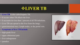 LIVER TB
• Liver TB is also called hepatic TB.
• It occurs when TB affects the liver.
• It accounts for less than 1 percent of all TB infections.
• Liver TB can spread to the liver from the lungs,
• gastrointestinal tract, lymph nodes, or the portal vein.
• Symptoms of liver TB include:
• high-grade fever
• upper abdominal pain
• liver enlargement
• jaundice
 
