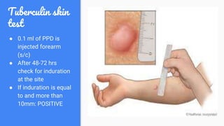 Tuberculosis | PPTX