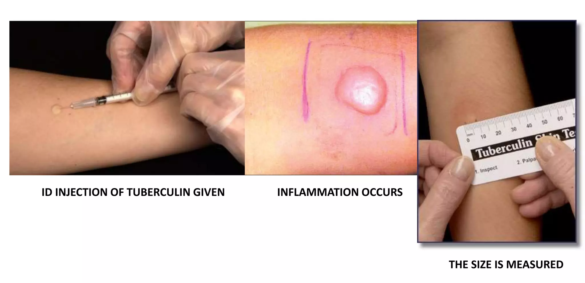 Tuberculosis | PPTX