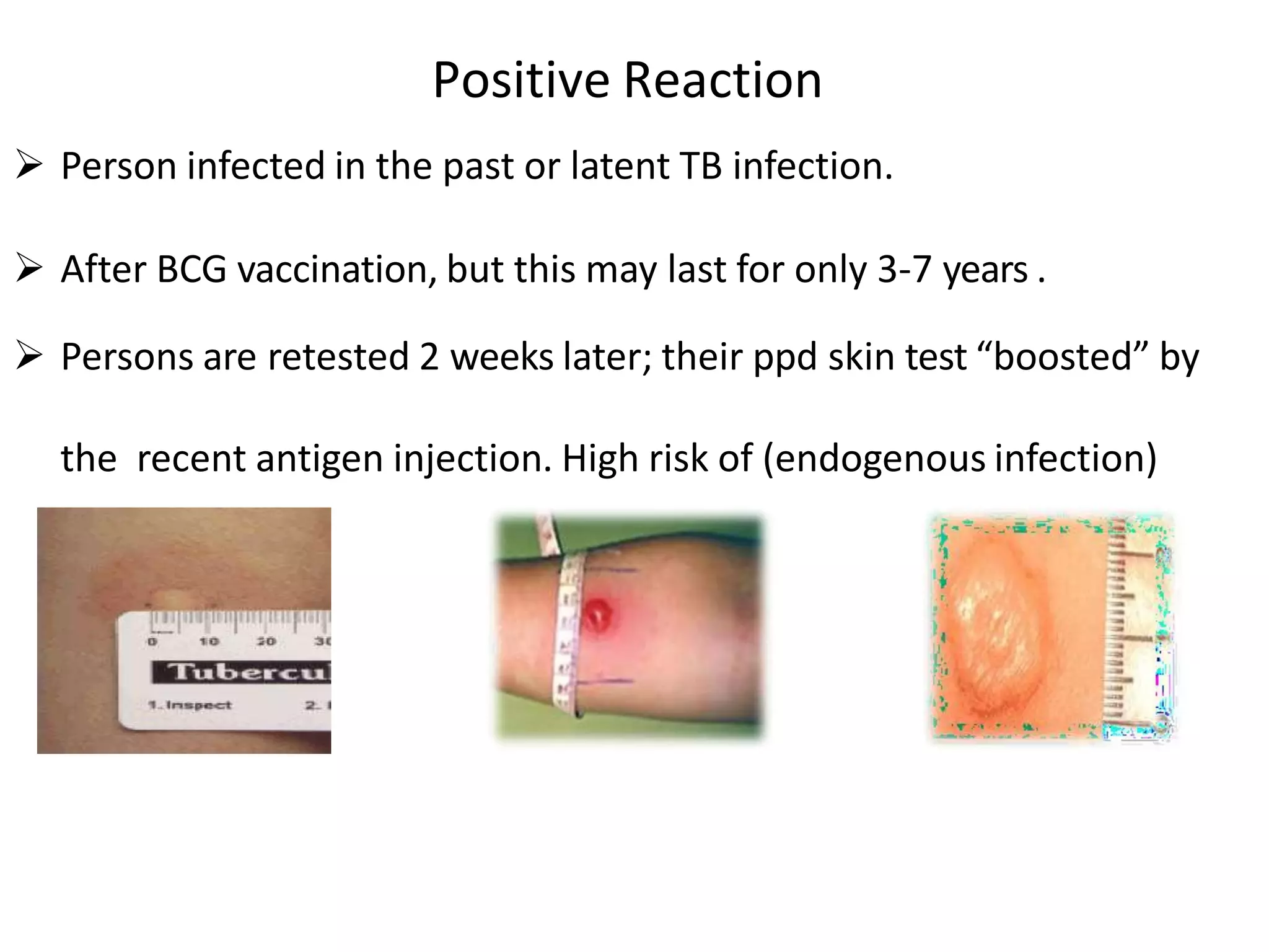 Tuberculosis Pdf 