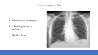 Tuberculosis miliar
• Diseminación hematógena
• Afección pulmonar y
sistémica
• Hígado y bazo
 