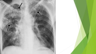 Pulmonary Tuberculosis.pptx