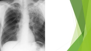 Pulmonary Tuberculosis.pptx