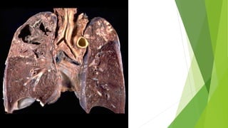Pulmonary Tuberculosis.pptx