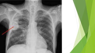 Pulmonary Tuberculosis.pptx