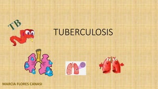 TUBERCULOSIS
MARCIA FLORES CANASI
 