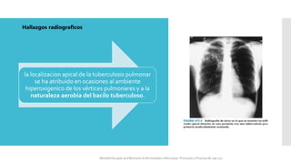 la localizacion apical de la tuberculosis pulmonar
se ha atribuido en ocasiones al ambiente
hiperoxigenico de los vértices pulmonares y a la
naturaleza aerobia del bacilo tuberculoso.
Hallazgos radiograficos
Mandell Douglas and Bennetts Enfermedades Infecciosas. Principios y Practica 8e cap 251.
 