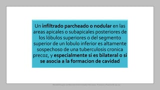 Un infiltrado parcheado o nodular en las
areas apicales o subapicales posteriores de
los lóbulos superiores o del segmento
superior de un lobulo inferior es altamente
sospechoso de una tuberculosis cronica
precoz, y especialmente si es bilateral o si
se asocia a la formacion de cavidad
Mandell Douglas and Bennetts Enfermedades Infecciosas. Principios y Practica 8e cap 251.
 
