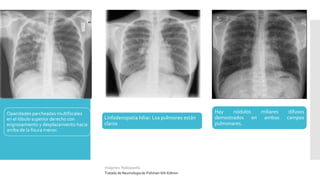 Opacidades parcheadas multifocales
en el lóbulo superior derecho con
engrosamiento y desplazamiento hacia
arriba de la fisura menor.
Hay nódulos miliares difusos
demostrados en ambos campos
pulmonares.
Linfadenopatía hiliar. Los pulmones están
claros
Imagenes: Radiopaedia
Tratado de Neumologia de-Fishman-6th-Edition
 