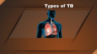 Types of TB
 