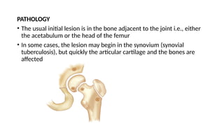 PATHOLOGY
• The usual initial lesion is in the bone adjacent to the joint i.e., either
the acetabulum or the head of the femur
• In some cases, the lesion may begin in the synovium (synovial
tuberculosis), but quickly the articular cartilage and the bones are
affected
 