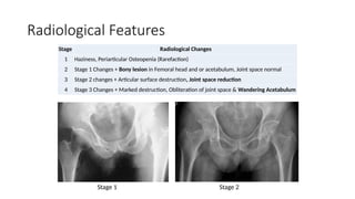 Radiological Features
Stage Radiological Changes
1 Haziness, Periarticular Osteopenia (Rarefaction)
2 Stage 1 Changes + Bony lesion in Femoral head and or acetabulum, Joint space normal
3 Stage 2 changes + Articular surface destruction, Joint space reduction
4 Stage 3 Changes + Marked destruction, Obliteration of joint space & Wandering Acetabulum
Stage 1 Stage 2
 