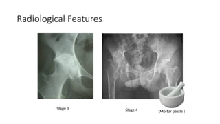 Radiological Features
Stage 3 Stage 4 (Mortar pestle )
 