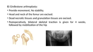 B) Girdlestone arthroplasty:
• Provide movement, No stability.
• Head and neck of the femur are excised.
• Dead necrotic tissues and granulation tissues are excised.
• Postoperatively, bilateral skeletal traction is given for 4 weeks,
followed by mobilization of the hip
 