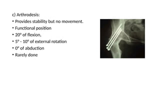 c) Arthrodesis:
• Provides stability but no movement.
• Functional position
• 20° of flexion,
• 5° - 10° of external rotation
• 0° of abduction
• Rarely done
 