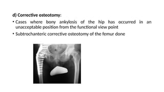 d) Corrective osteotomy:
• Cases where bony ankylosis of the hip has occurred in an
unacceptable position from the functional view point
• Subtrochanteric corrective osteotomy of the femur done
 