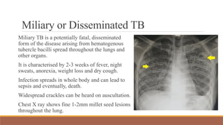 Miliary or Disseminated TB
Miliary TB is a potentially fatal, disseminated
form of the disease arising from hematogenous
tubercle bacilli spread throughout the lungs and
other organs.
It is characterised by 2-3 weeks of fever, night
sweats, anorexia, weight loss and dry cough.
Infection spreads in whole body and can lead to
sepsis and eventually, death.
Widespread crackles can be heard on auscultation.
Chest X ray shows fine 1-2mm millet seed lesions
throughout the lung.
 