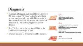 Diagnosis
Mantoux tuberculin skin test (TST): A positive
TB skin test or TB blood test only tells that a
person has been infected with TB bacteria. It
does not tell whether the person has latent TB
infection (LTBI) or has progressed to TB
disease.
The TB skin test is the preferred TB test for
children under the age of five.
Sputum analysis is preferred in older patients.
 