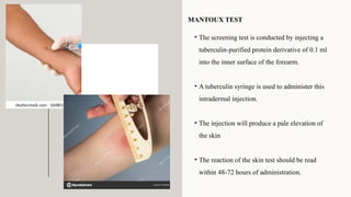 • The screening test is conducted by injecting a
tuberculin-purified protein derivative of 0.1 ml
into the inner surface of the forearm.
• A tuberculin syringe is used to administer this
intradermal injection.
• The injection will produce a pale elevation of
the skin
• The reaction of the skin test should be read
within 48-72 hours of administration.
MANTOUX TEST
 