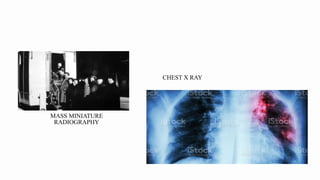 MASS MINIATURE
RADIOGRAPHY
CHEST X RAY
 