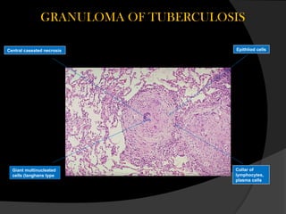 Caseated Comprehensive Overview of Tuberculosis: Pathogenesis, Diagnosis, and ...