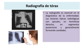 Radiografía de tórax
• La radiografía es esencial en el
diagnóstico de la enfermedad.
Las lesiones típicas radiológicas
son apicales, en hemitórax
derecho, en segmentos
posteriores y generalmente
formando cavidades.
 