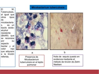 Micobacterium tuberculosis
a b
Presencia de
Micobacterium
tuberculosis en el tejido
pulmonar
frotis de esputo puesto en
evidencia mediante el
método de tinción de Ziehl-
Neelsen
El M.
Tuberculosis,
al igual que
otros tipos
de
micobacteria
s, es un
bacilo ácido-
alcohol
resistente
(BAAR) que
se reconoce
por su
aspecto
bacilar y el
color rojo
que adquiere
a la tinción
referida.
 