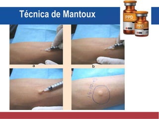 c d
Técnica de Mantoux
 