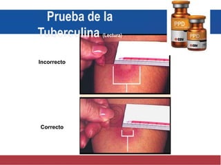Incorrecto
Correcto
Prueba de la
Tuberculina (Lectura)
 