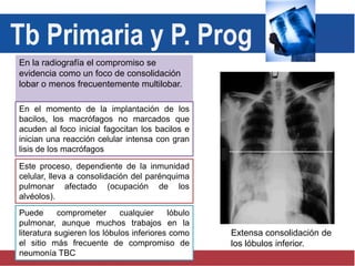 En la radiografía el compromiso se
evidencia como un foco de consolidación
lobar o menos frecuentemente multilobar.
En el momento de la implantación de los
bacilos, los macrófagos no marcados que
acuden al foco inicial fagocitan los bacilos e
inician una reacción celular intensa con gran
lisis de los macrófagos
Este proceso, dependiente de la inmunidad
celular, lleva a consolidación del parénquima
pulmonar afectado (ocupación de los
alvéolos).
Extensa consolidación de
los lóbulos inferior.
Tb Primaria y P. Prog
Puede comprometer cualquier lóbulo
pulmonar, aunque muchos trabajos en la
literatura sugieren los lóbulos inferiores como
el sitio más frecuente de compromiso de
neumonía TBC
 