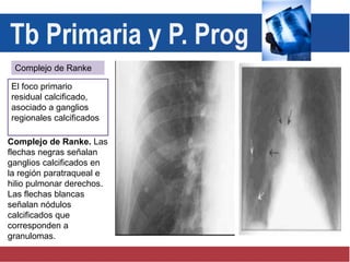 Complejo de Ranke
El foco primario
residual calcificado,
asociado a ganglios
regionales calcificados
Complejo de Ranke. Las
flechas negras señalan
ganglios calcificados en
la región paratraqueal e
hilio pulmonar derechos.
Las flechas blancas
señalan nódulos
calcificados que
corresponden a
granulomas.
Tb Primaria y P. Prog
 
