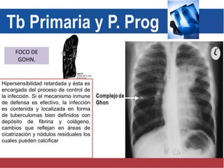 FOCO DE
GOHN.
Tb Primaria y P. Prog
Hipersensibilidad retardada y ésta es
encargada del proceso de control de
la infección. Si el mecanismo inmune
de defensa es efectivo, la infección
es contenida y localizada en forma
de tuberculomas bien definidos con
depósito de fibrina y colágeno,
cambios que reflejan en áreas de
cicatrización y nódulos residuales los
cuales pueden calcificar
 