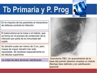En la mayoría de los pacientes el mecanismo
de defensa controla la infección.
El tuberculoma es la masa o el nódulo, que
se forma en el proceso de contención de la
infección por parte de la inmunidad del
sujeto.
Su tamaño suele ser menor de 3 cm, pero
masas de mayor tamaño han sido
reportadas. Se localizan especialmente en
los lóbulos superiores.
La mitad de ellos terminan calcificando.
Granuloma TBC. Un acercamiento de la
base del pulmón derecho muestra un nódulo
(flechas) bien definido y sin calcificación
aparente
Tb Primaria y P. Prog
 