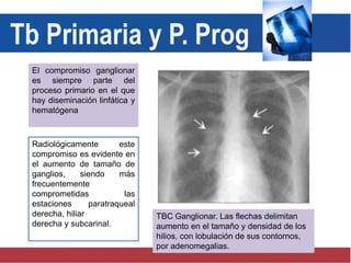 El compromiso ganglionar
es siempre parte del
proceso primario en el que
hay diseminación linfática y
hematógena
Radiológicamente este
compromiso es evidente en
el aumento de tamaño de
ganglios, siendo más
frecuentemente
comprometidas las
estaciones paratraqueal
derecha, hiliar
derecha y subcarinal.
Tb Primaria y P. Prog
TBC Ganglionar. Las flechas delimitan
aumento en el tamaño y densidad de los
hilios, con lobulación de sus contornos,
por adenomegalias.
 
