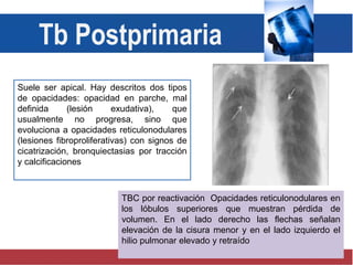 Suele ser apical. Hay descritos dos tipos
de opacidades: opacidad en parche, mal
definida (lesión exudativa), que
usualmente no progresa, sino que
evoluciona a opacidades reticulonodulares
(lesiones fibroproliferativas) con signos de
cicatrización, bronquiectasias por tracción
y calcificaciones
Tb Postprimaria
TBC por reactivación Opacidades reticulonodulares en
los lóbulos superiores que muestran pérdida de
volumen. En el lado derecho las flechas señalan
elevación de la cisura menor y en el lado izquierdo el
hilio pulmonar elevado y retraído
 