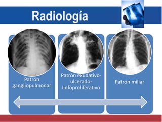 Patrón
gangliopulmonar
Patrón exudativo-
ulcerado-
linfoproliferativo
Patrón miliar
Radiología
 