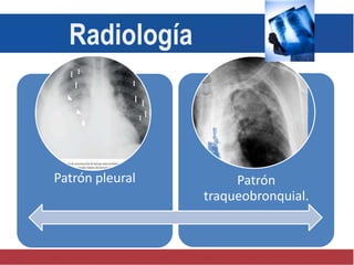 Patrón pleural Patrón
traqueobronquial.
Radiología
 